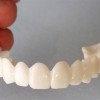Какие зубы лучше вставить: пластмассовые или керамические?